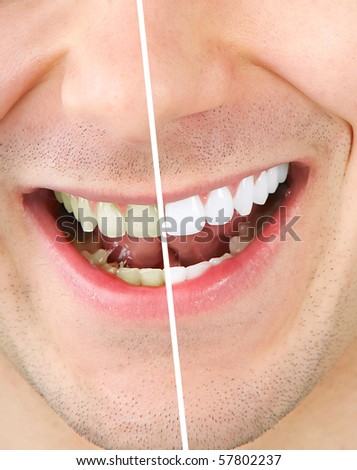 Male teeth before and after whitening