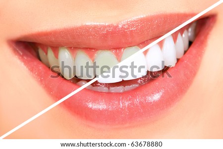 Beautiful young woman teeth. Whitening