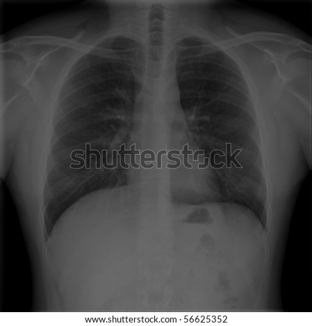 X-Rays of male chests and lungs taken from back