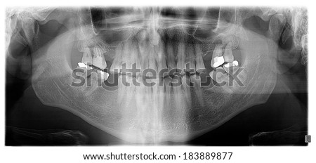 Dental panoramic x-ray showing granuloma at upper second and third molar on the left and missing first molars on both sides. First signs of periodontitis.