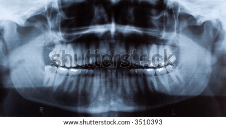 Male dental x-ray showing teeth fillings