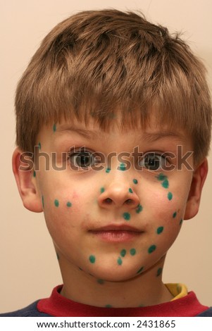 A boy with green dots - a medication used in case of being ill in chickenpox