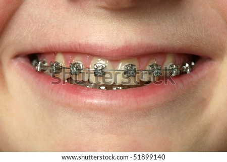 teeth braces colors. stock photo : Dental braces on
