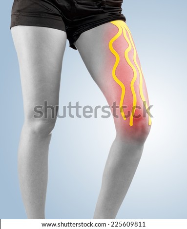 Injured knee treated with tape therapy.