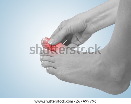 Painful and inflamed gout on his foot around the big toe area.