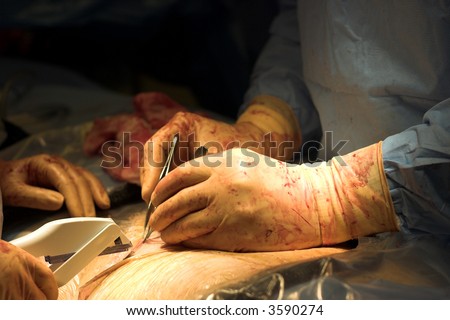 Surgeons finish up a cesarean section operation (c-section) by stapling the final layer of skin.