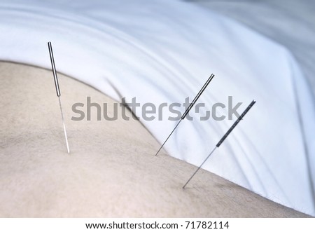 Closeup of acupuncture needles inserted in man\'s shoulder