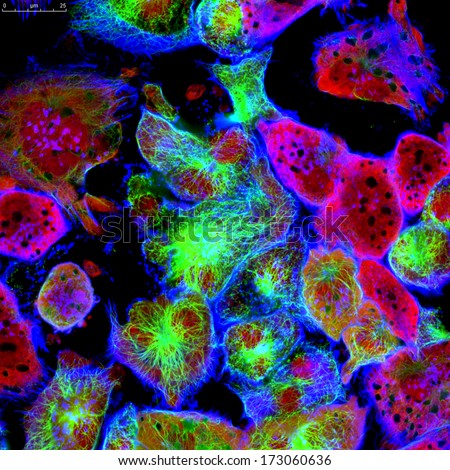 Tumor cells under microscope labeled with fluorescent molecules