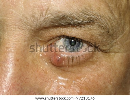 Man with a medical condition called a sty in the eye lid
