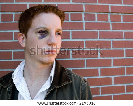 Young man with black eye that is starting to heal