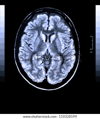 Health medical image of an MRI / MRA (Magnetic Resonance Angiogram)  of the head showing the brain