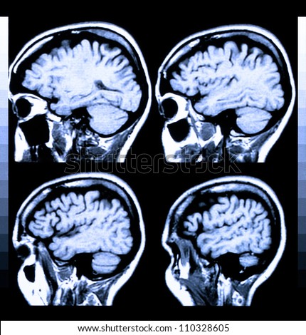 Health medical image of an MRI / MRA (Magnetic Resonance Angiogram)  of the head showing the brain