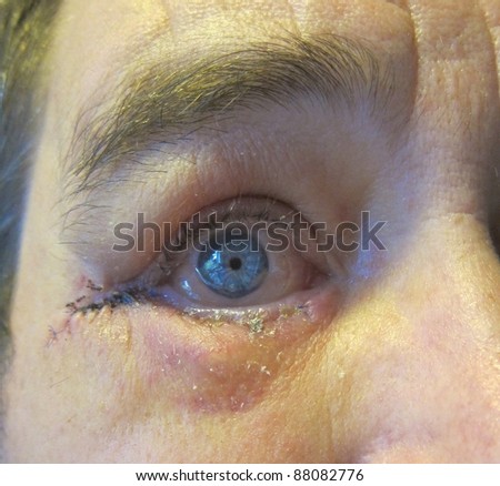 post operation eyelid lift in detail view