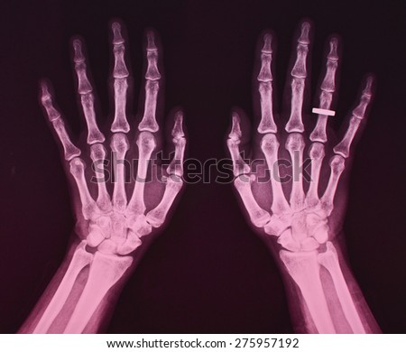 X ray of both hands, female
