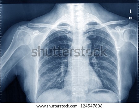 X-Ray Image Of Human Chest For A Medical Diagnosis