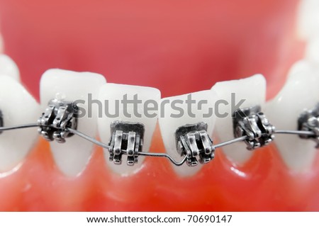 Dental braces super macro ,  crooked teeth , shallow depth of field