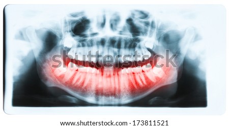 Panoramic x-ray image of teeth and mouth with all four molars vertically impacted and still not grown and visible in the jaw bone. Filled cavities visible. Teeth on lower jaw shown red.
