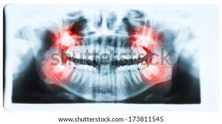 Panoramic x-ray image of teeth and mouth with all four molars vertically impacted. Filled cavities visible. Impacted wisdom teeth (number 8) on the right side of the face (image left) shown red.