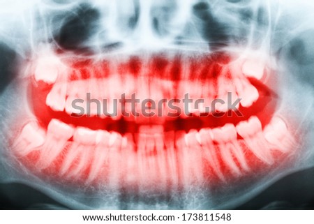 Close-up x-ray image of teeth and mouth with all four molars vertically impacted and still not grown and visible in the jaw bone. Filled cavities visible. Teeth shown in red.
