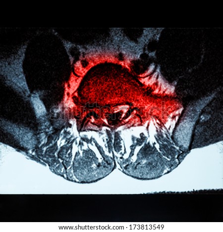 Magnetic resonance imaging (MRI) of lumbo-sacral spines demonstrating herniated disc at L3-L4 and L4-L5 with red color