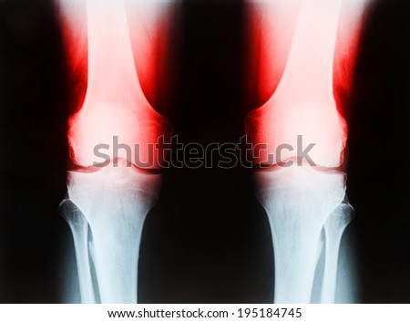 X-ray of a senior male right and left knee showing tibia and fibula bones of both legs, with femur bones highlighted in red