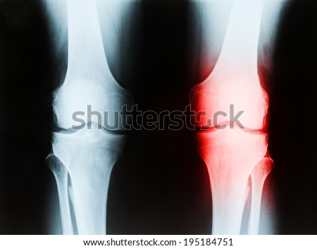X-ray of a senior male right and left knee showing tibia and fibula bones of both legs, with patient\'s left joint area highlighted in red