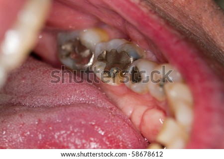 Chipped Molar Tooth Pain