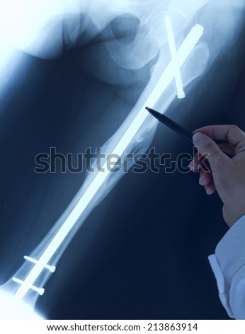 Doctor orthopedist examine x-ray with broken leg after surgery