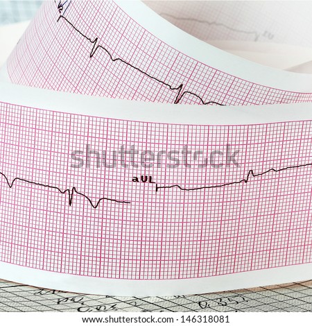 Cardiogram on the pink grid. The concept for strokes and heart attacks