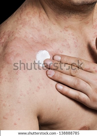 Man applying cream on irritated skin