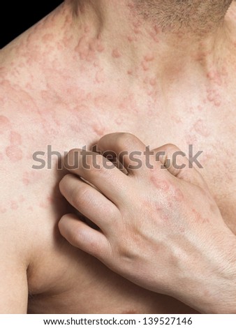 Man scratching itchy skin