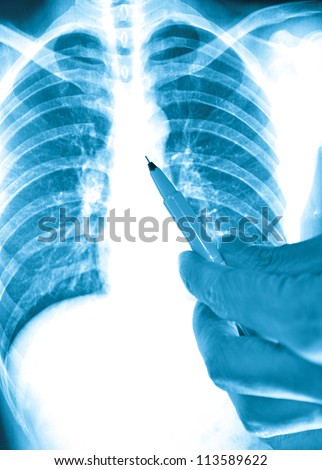 showing x-ray picture of human lumbar vertebra bone