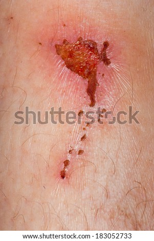 medical incrustation scab skin of patient