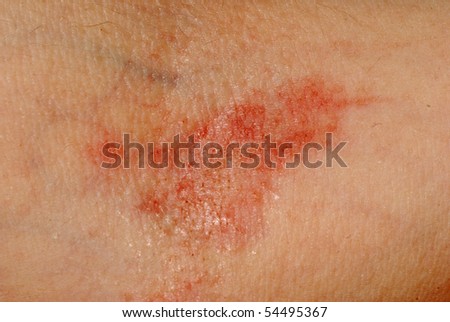 poison oak pictures on skin. poison oak rash pics. small