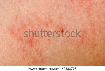 skin allergy rash