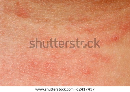 poison oak pictures on skin. mild poison oak rash pictures.