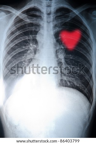 x-ray heart of human