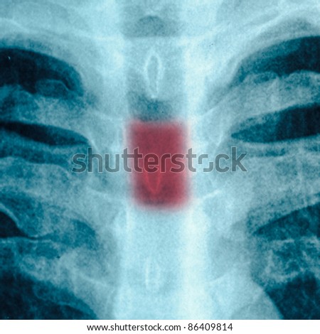 x-ray of chest of human vertebra