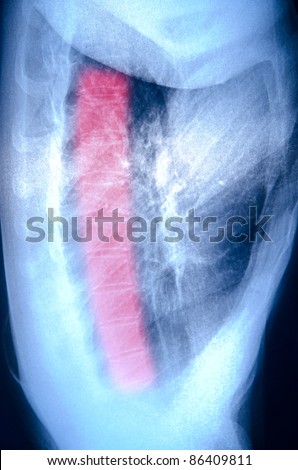 x-ray of chest of human vertebra