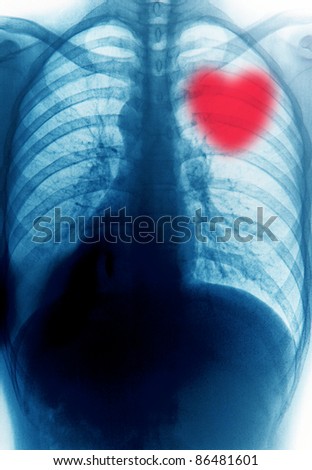 x-ray red heart