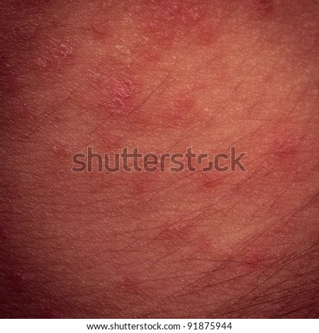 human skin eczema symptom detail medical background