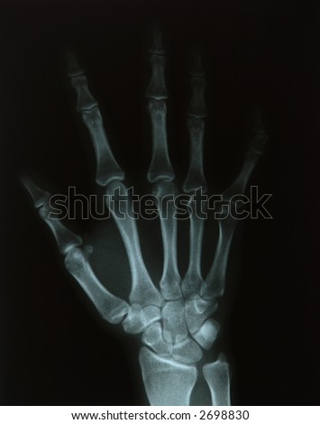 X-ray of a young woman\'s hand