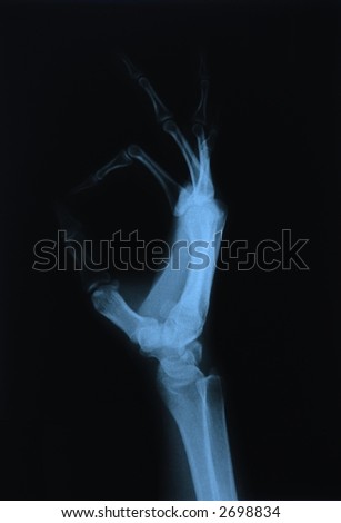 X-ray of a young woman's hand