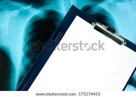 Empty document in a clipboard on Xray photo of lungs