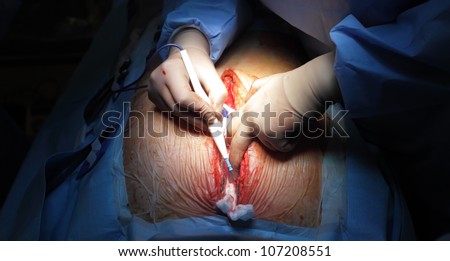 Sternotomy. Treatment of the wound edges. Removal of bleeding.