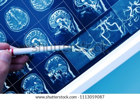 Doctor pointing with pen to the brain blood vessel on the MRI image.