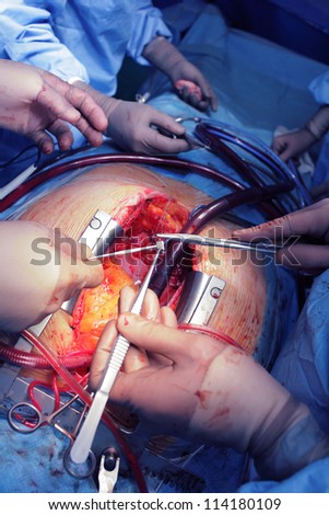 Teamwork of surgeons on the open heart