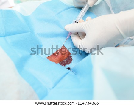 patient having an injection. Sterile surgical field and the hands of doctor with a big needle.