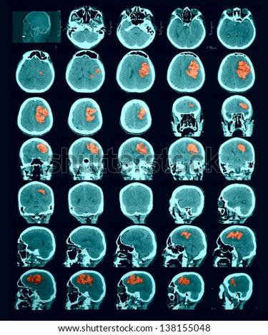 CT scan of the brain. Hemorrhagic stroke. red us to identify the lesion focus. Documentary photography. Information for professionals.