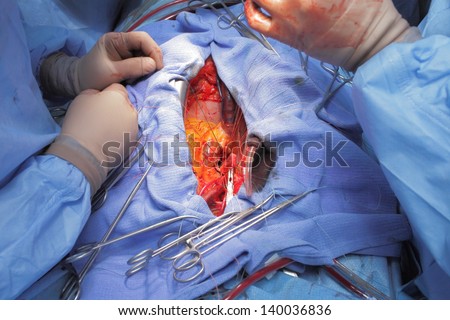 Aortic valve replacement. Open heart.